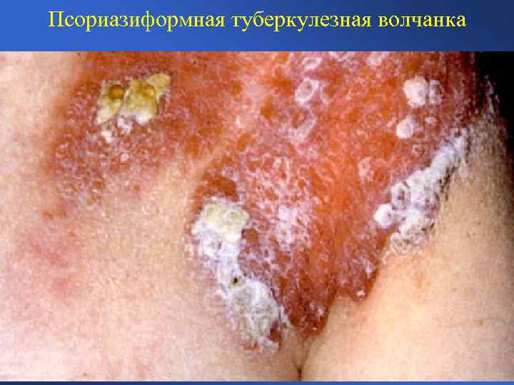 Псориазиформная туберкулезная волчанка 