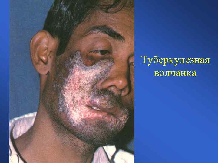 Туберкулезная волчанка 