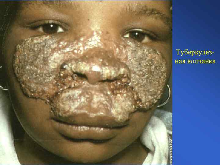 Туберкулезная волчанка 