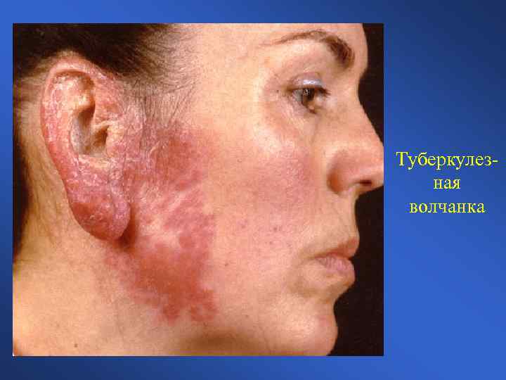 Туберкулезная волчанка 