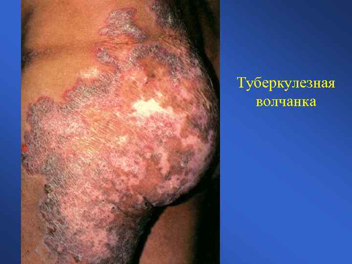 Туберкулезная волчанка 