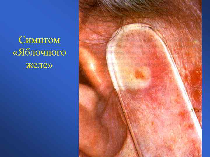 Симптом «Яблочного желе» 