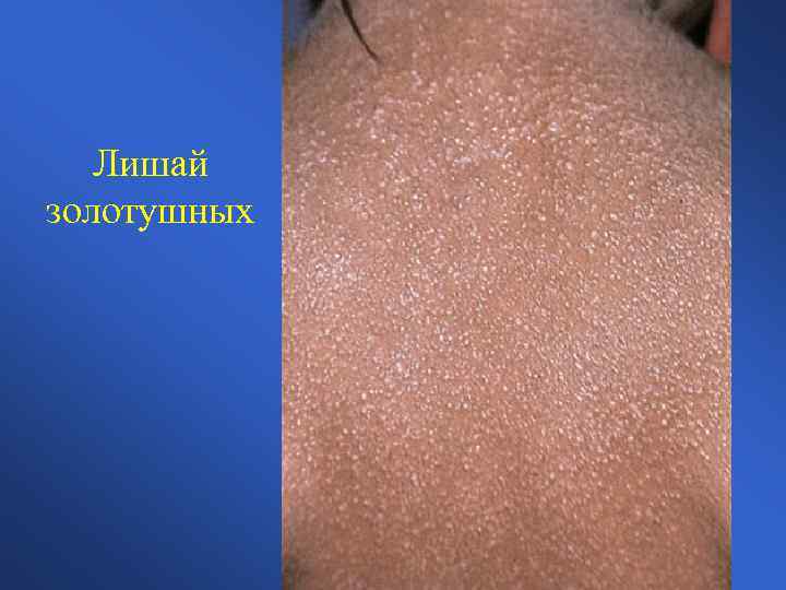 Лишай золотушных 