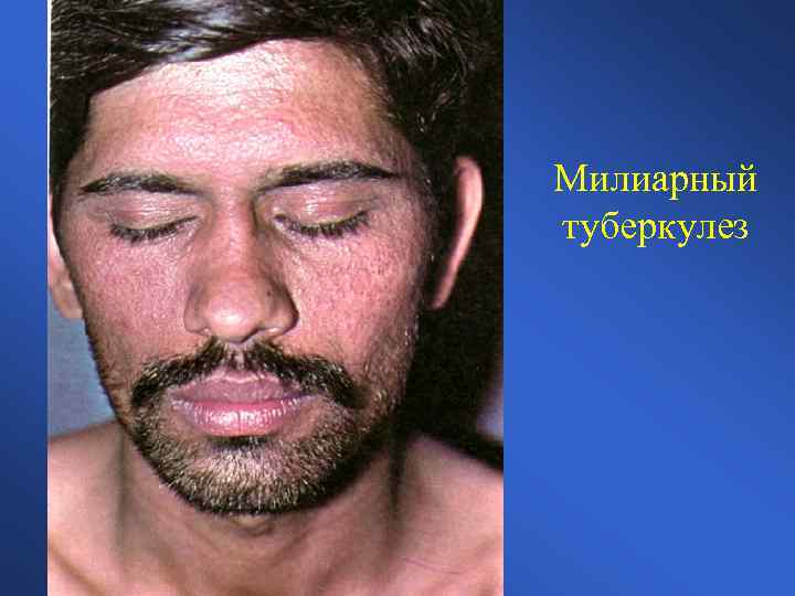 Милиарный туберкулез 