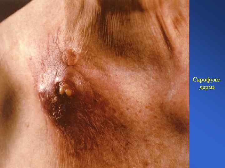 Скрофулодерма 