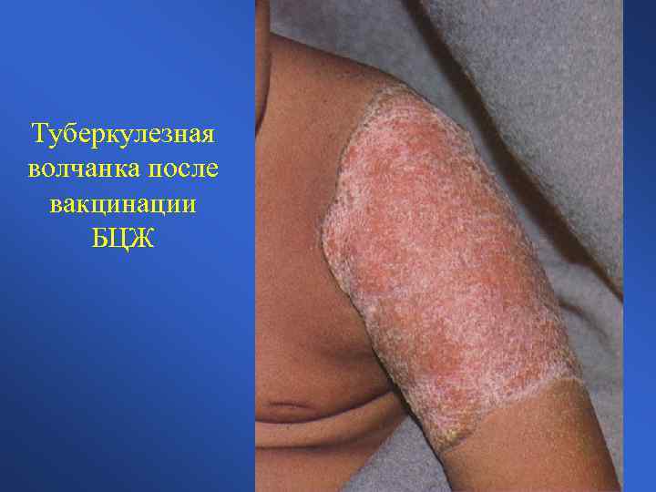 Туберкулезная волчанка после вакцинации БЦЖ 