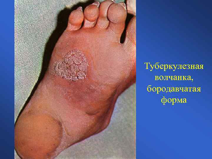 Туберкулезная волчанка, бородавчатая форма 