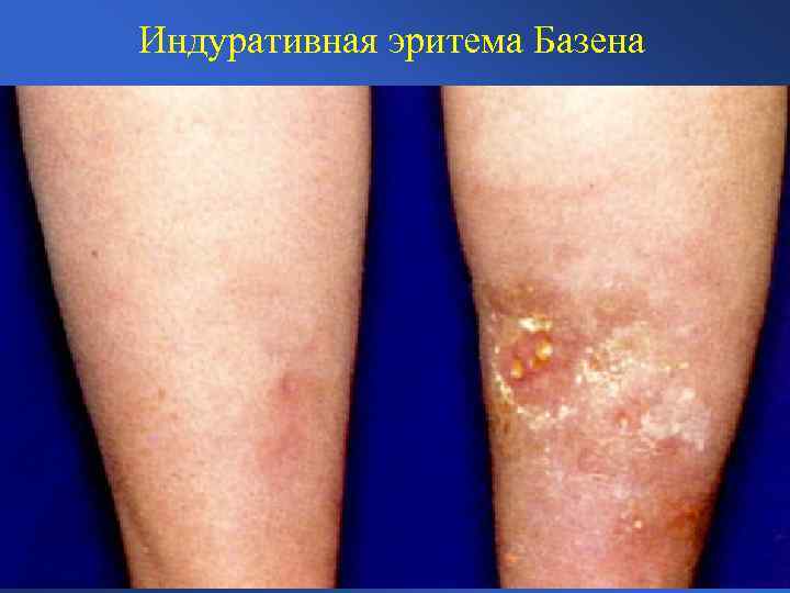 Индуративная эритема Базена 