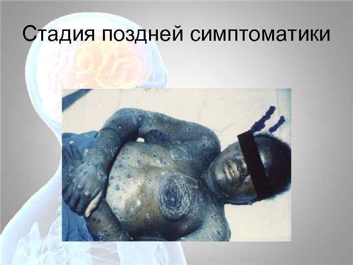 Стадия поздней симптоматики 