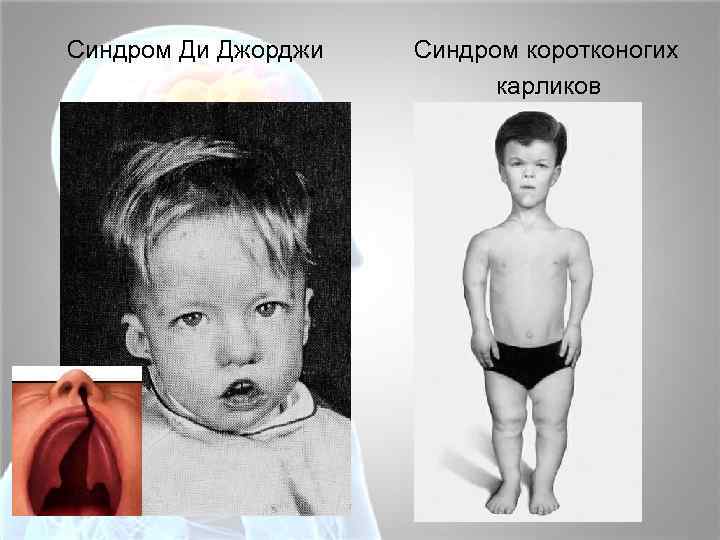 Синдром Ди Джорджи Синдром коротконогих карликов 
