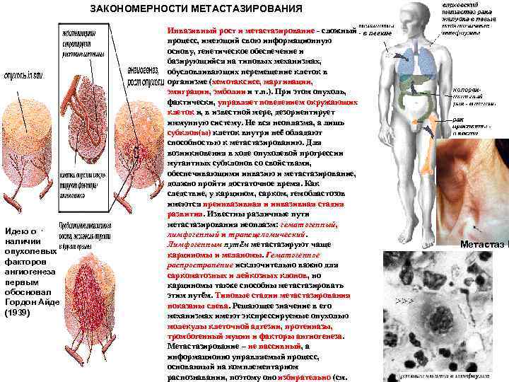 ЗАКОНОМЕРНОСТИ МЕТАСТАЗИРОВАНИЯ Идею о наличии опухолевых факторов ангиогенеза первым обосновал Гордон Айде (1939) Инвазивный