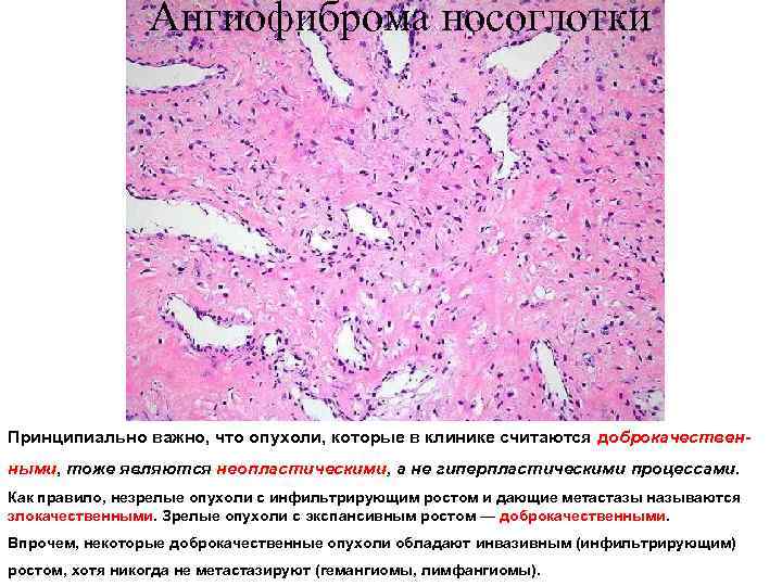 Ангиофиброма носоглотки Принципиально важно, что опухоли, которые в клинике считаются доброкачественными, тоже являются неопластическими,