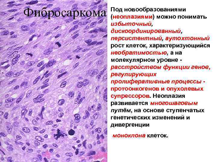 Фибросаркома микропрепарат рисунок