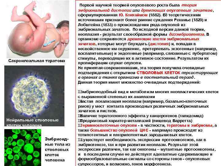  Первой научной теорией опухолевого роста была теория Сакроилеальная тератома Нейральные стволовые клетки человека