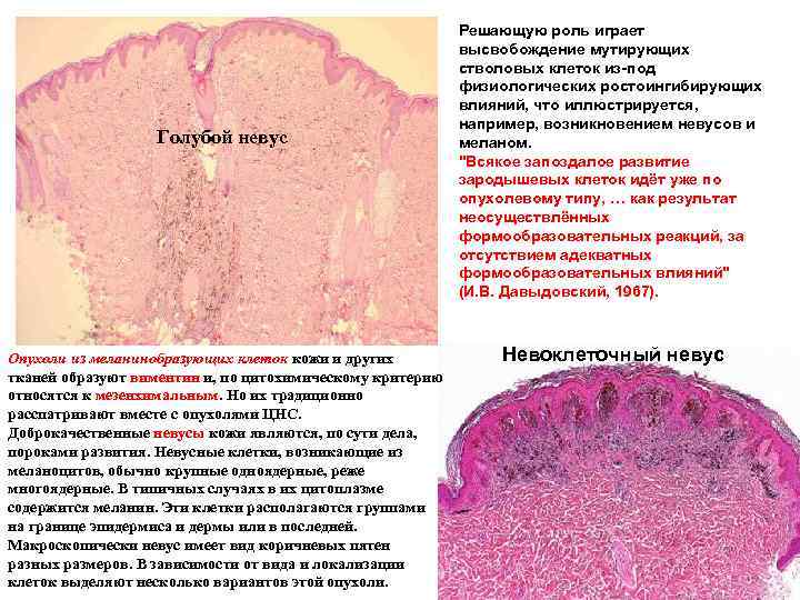 Голубой невус Опухоли из меланинобразующих клеток кожи и других тканей образуют виментин и, по