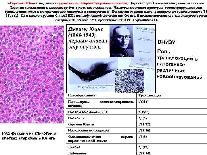  «Саркома» Юинга опухоль из примитивных нейроэктодермальных клеток. Поражает детей и подростков, чаще мальчиков.