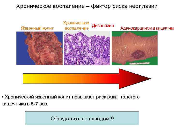 Хроническое воспаление – фактор риска неоплазии Язвенный колит Хроническое Дисплазия воспаление Аденокарцинома кишечник •