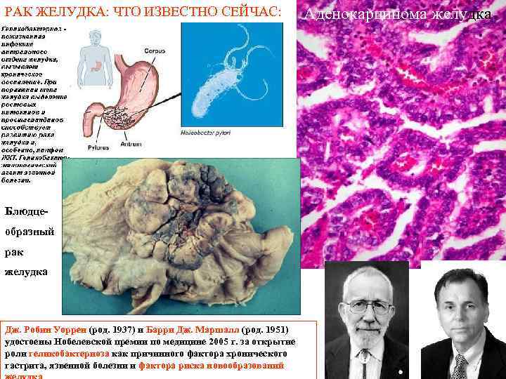 РАК ЖЕЛУДКА: ЧТО ИЗВЕСТНО СЕЙЧАС: Блюдце образный рак желудка Дж. Робин Уоррен (род. 1937)