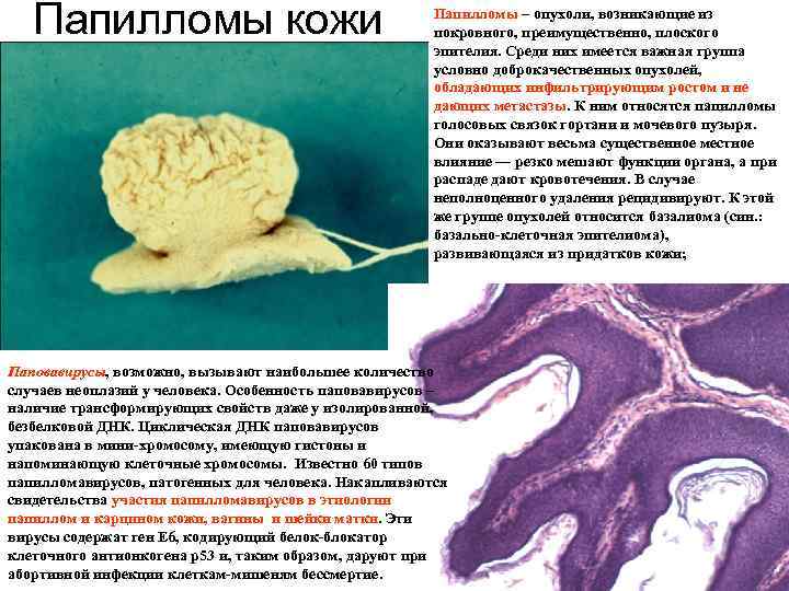 Папилломы кожи Папилломы – опухоли, возникающие из покровного, преимущественно, плоского эпителия. Среди них имеется