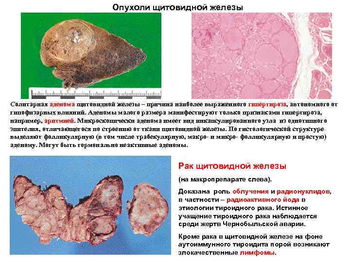 Опухоли щитовидной железы Солитарная аденома щитовидной железы – причина наиболее выраженного гипертироза, автономного от