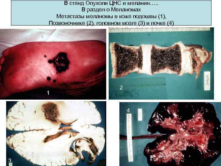 В стенд Опухоли ЦНС и меланин…. . В раздел о Меланомах Метастазы меланомы в