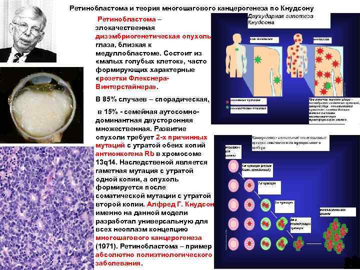 Ретинобластома и теория многошагового канцерогенеза по Кнудсону Ретинобластома – злокачественная дизэмбриогенетическая опухоль глаза, близкая