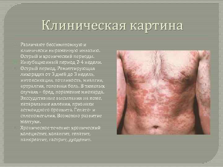 Клиническая картина Различают бессимптомную и клинически выраженную инвазию. Острый и хронический периоды. Инкубационный период