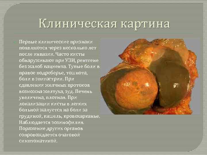 Клиническая картина Первые клинические признаки появляются через несколько лет после инвазии. Часто кисты обнаруживают