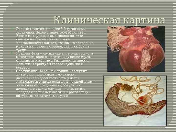 Клиническая картина Первые симптомы – через 2 -3 суток после заражения. Недомогание, субфебрилитет. Возможны