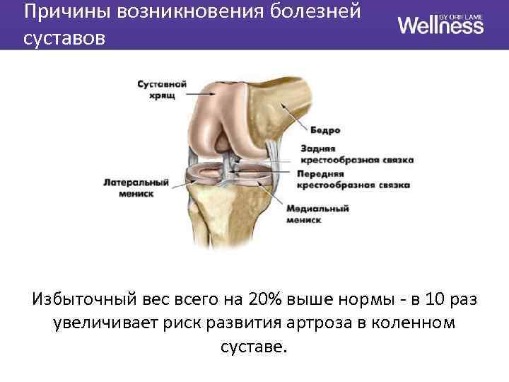 Причины возникновения болезней суставов Избыточный вес всего на 20% выше нормы - в 10