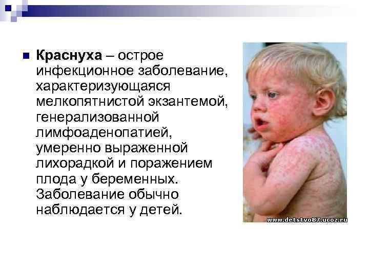 n Краснуха – острое инфекционное заболевание, характеризующаяся мелкопятнистой экзантемой, генерализованной лимфоаденопатией, умеренно выраженной лихорадкой