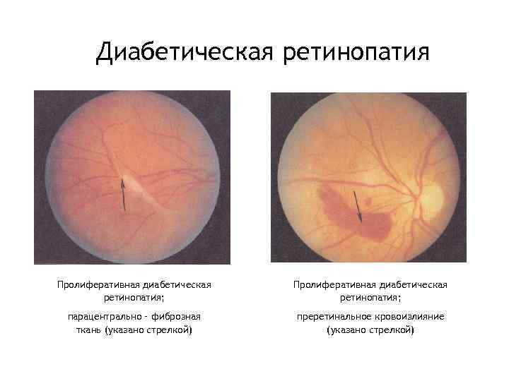  Диабетическая ретинопатия Пролиферативная диабетическая ретинопатия; парацентрально – фиброзная преретинальное кровоизлияние ткань (указано стрелкой)