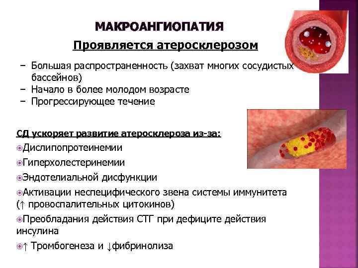  МАКРОАНГИОПАТИЯ Проявляется атеросклерозом − Большая распространенность (захват многих сосудистых бассейнов) − Начало в