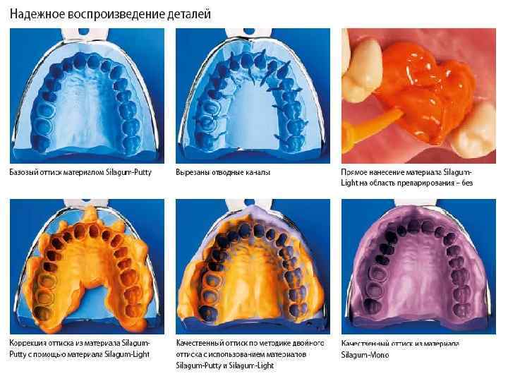 Оттиски в ортопедической стоматологии презентация