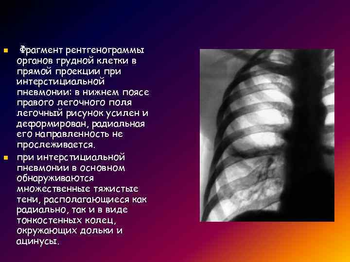 Усиление легочного рисунка за счет интерстициального компонента