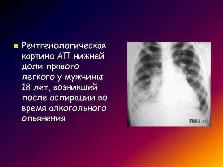 n Рентгенологическая картина АП нижней доли правого легкого у мужчины 18 лет, возникшей после