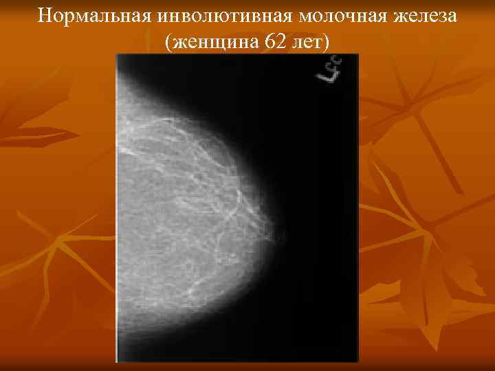 Нормальная инволютивная молочная железа (женщина 62 лет) 