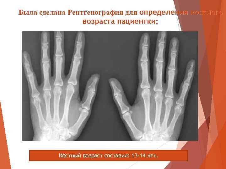 Была сделана Рентгенография для определения костного возраста пациентки: Костный возраст составил: 13 -14 лет.