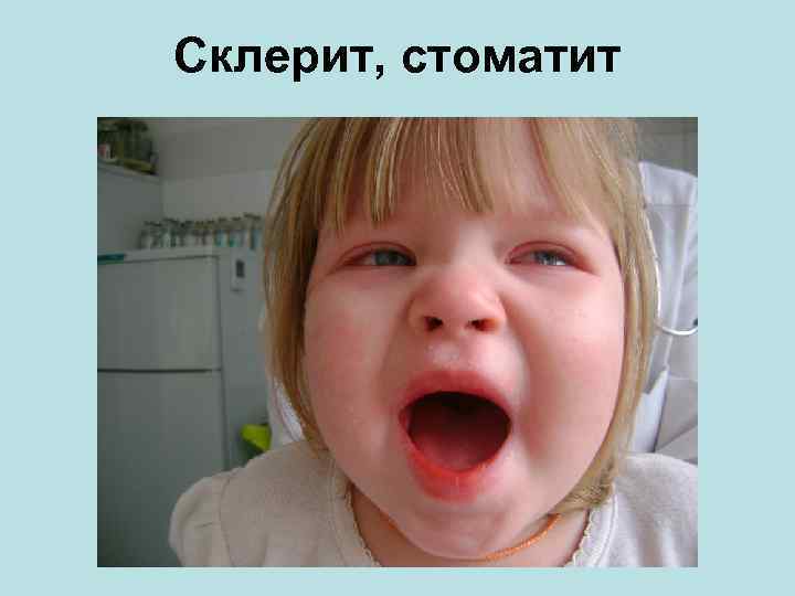 Склерит, стоматит 