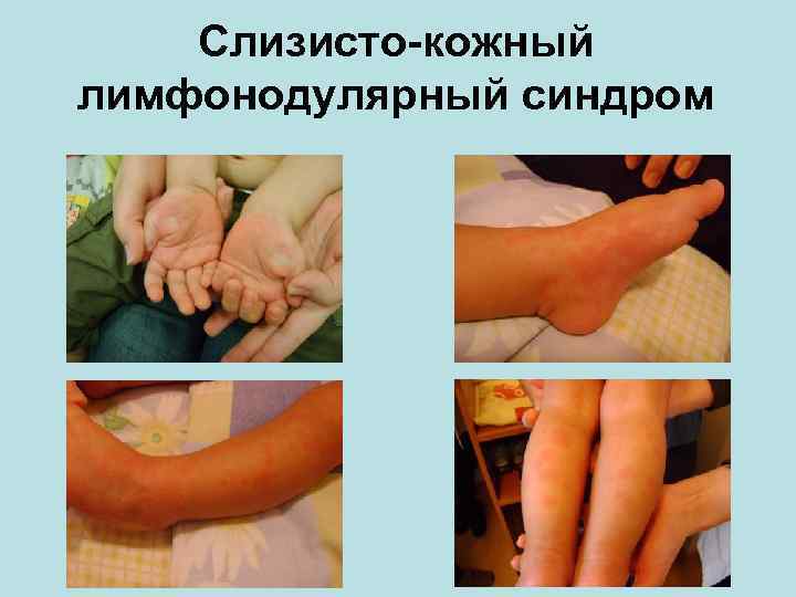 Слизисто-кожный лимфонодулярный синдром 