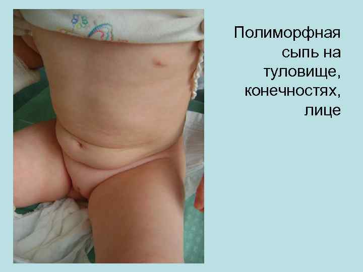 Полиморфная сыпь на туловище, конечностях, лице 