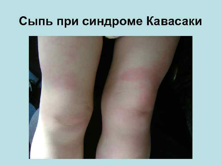 Сыпь при синдроме Кавасаки 