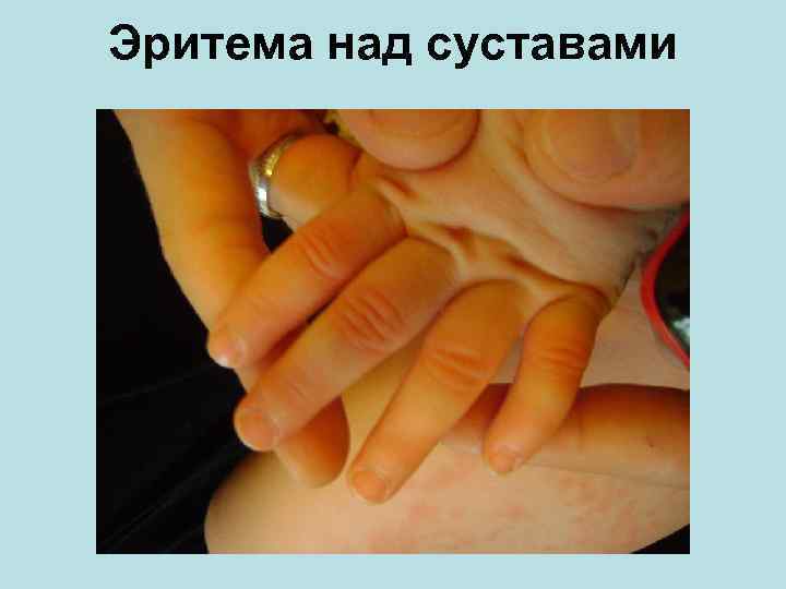 Эритема над суставами 
