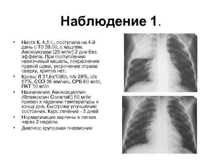 Симптомы пневмонии у взрослого без кашля