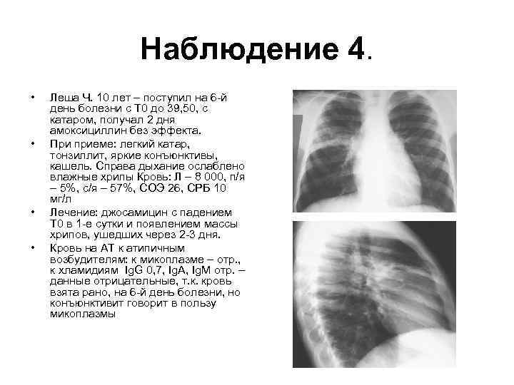 Наблюдение 4. • • Леша Ч. 10 лет – поступил на 6 -й день