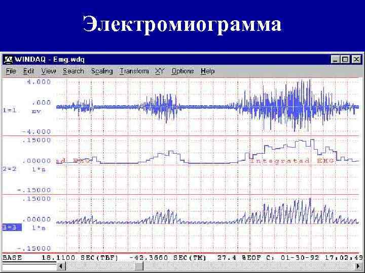 Электромиограмма 