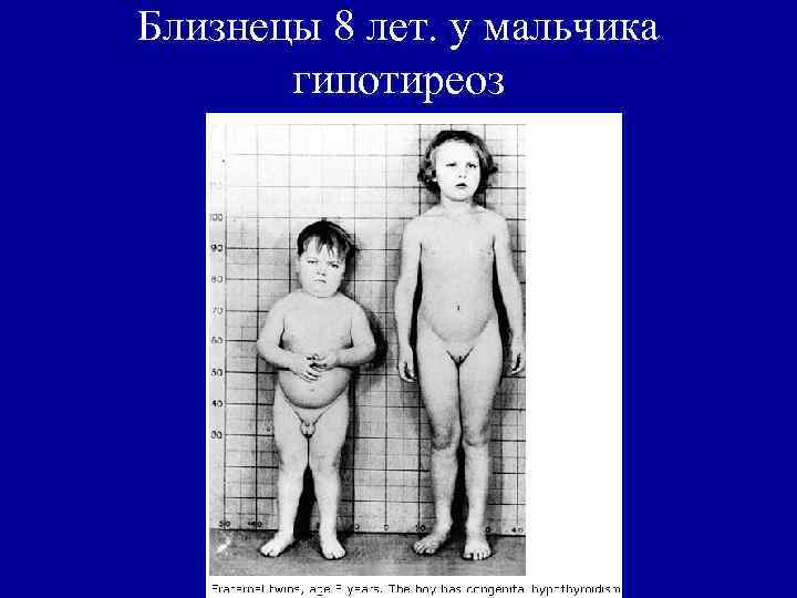 Близнецы 8 лет. у мальчика гипотиреоз 