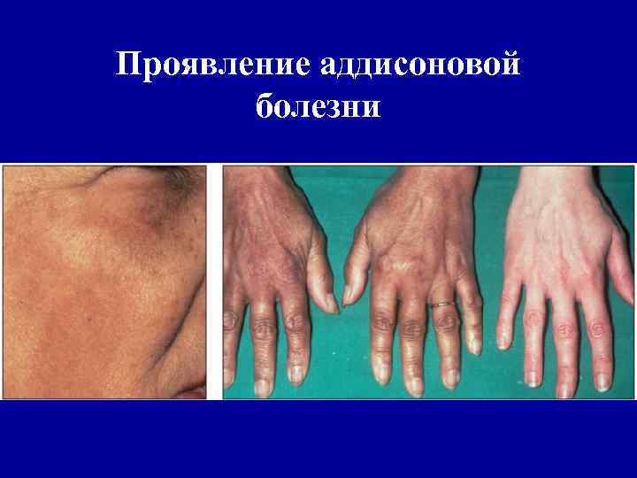 Проявление аддисоновой болезни 