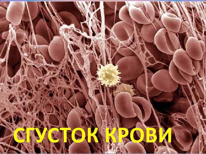 СГУСТОК КРОВИ 