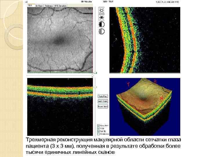 Трехмерная реконструкция макулярной области сетчатки глаза пациента (3 х 3 мм), полученная в результате
